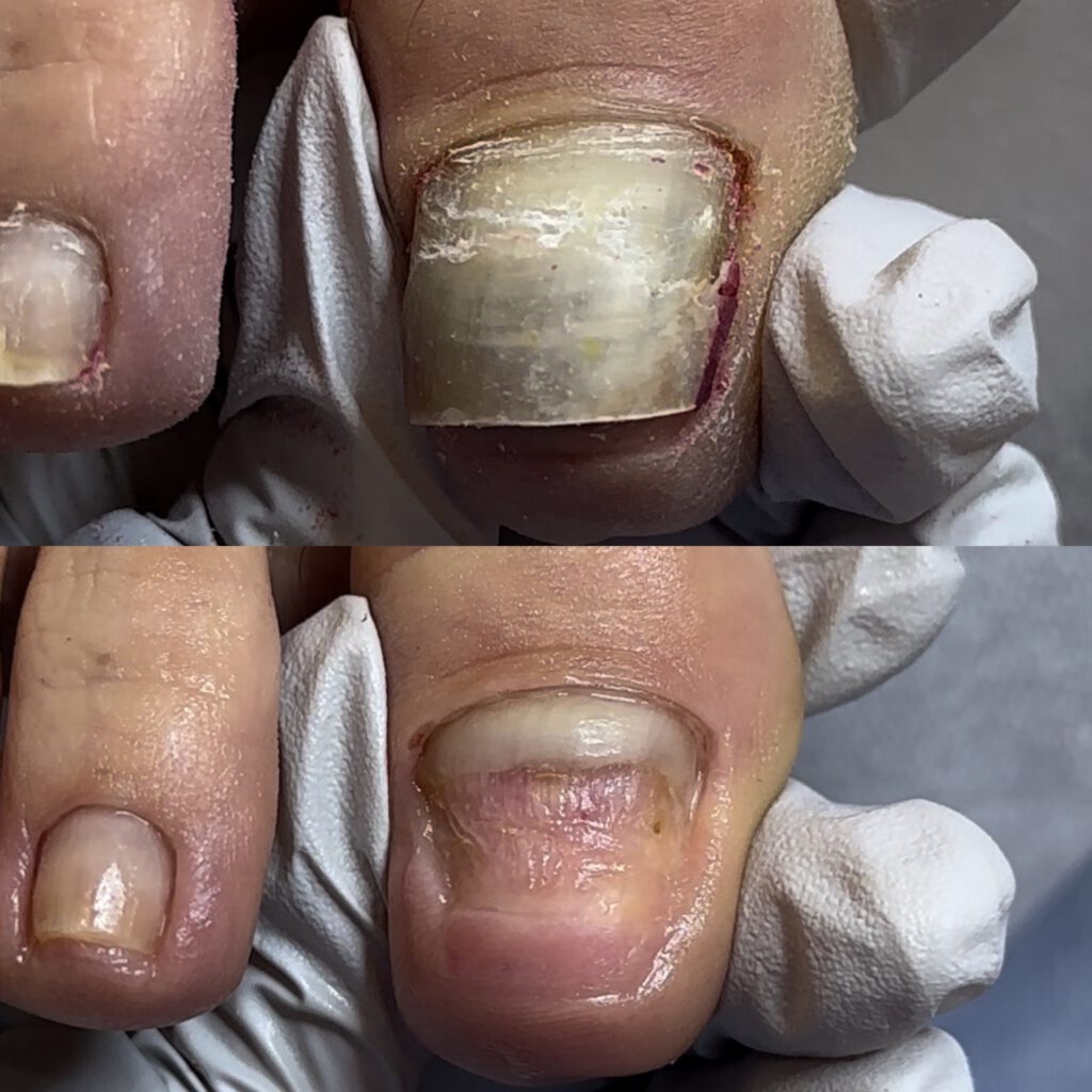 Paramedical Pedicure 1