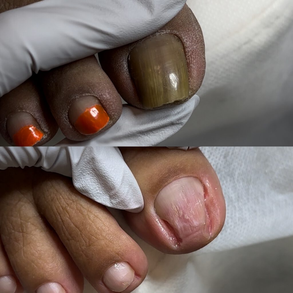 Paramedical Pedicure 4