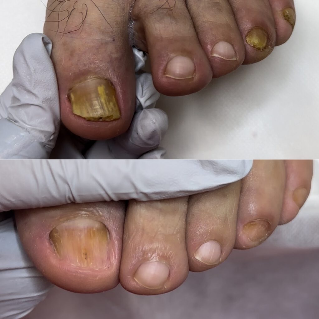 Paramedical Pedicure 5