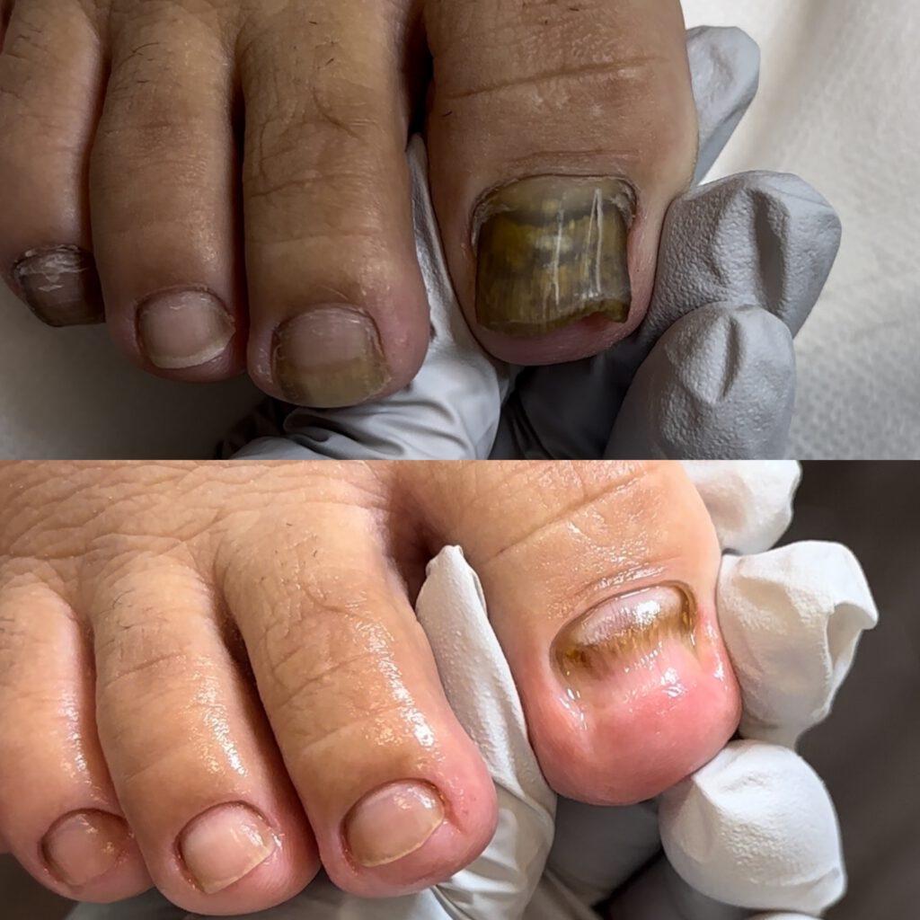 Paramedical Pedicure 6