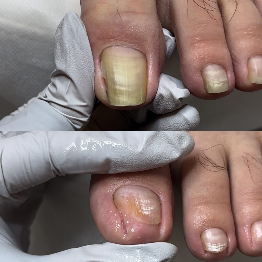 Paramedical Pedicure 7