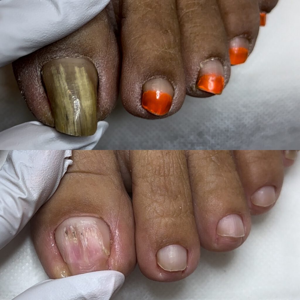 Paramedical Pedicure 9